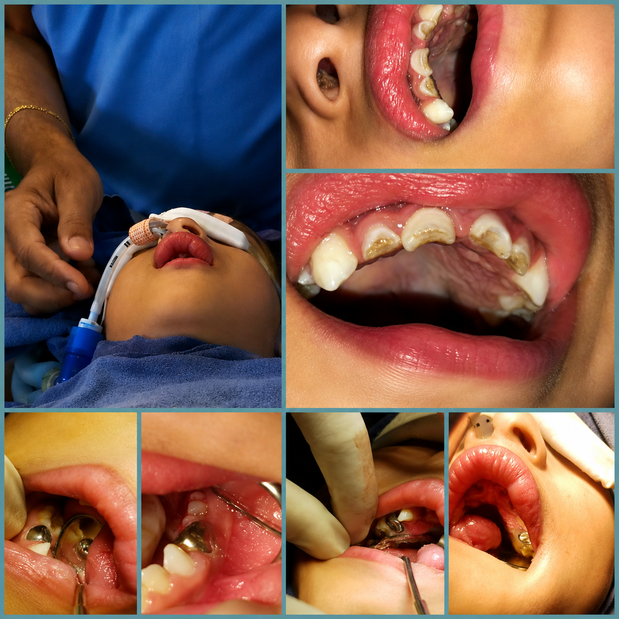 Cavity-Free Smiling Patient at Pediatric Dental Clinic